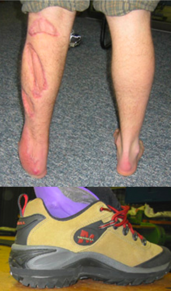 Injured Leg with Custom Orthotic